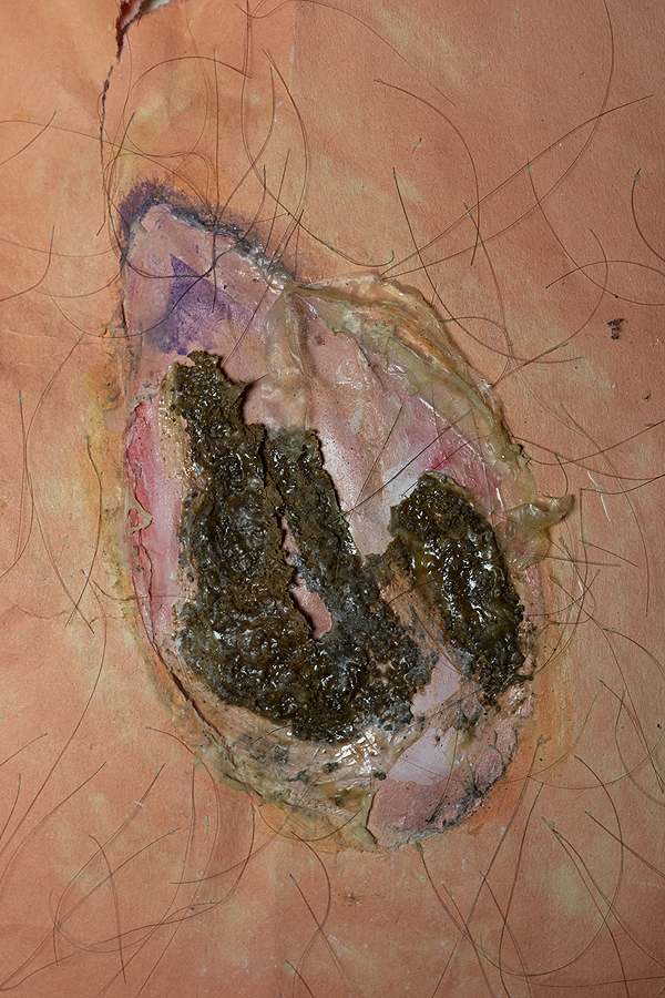 This is a picture of a simulated scab with an open wound and hairy skin by Richard Haley
